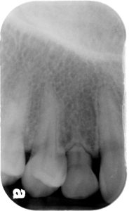 Scanned X-ray_Periapical_20191120